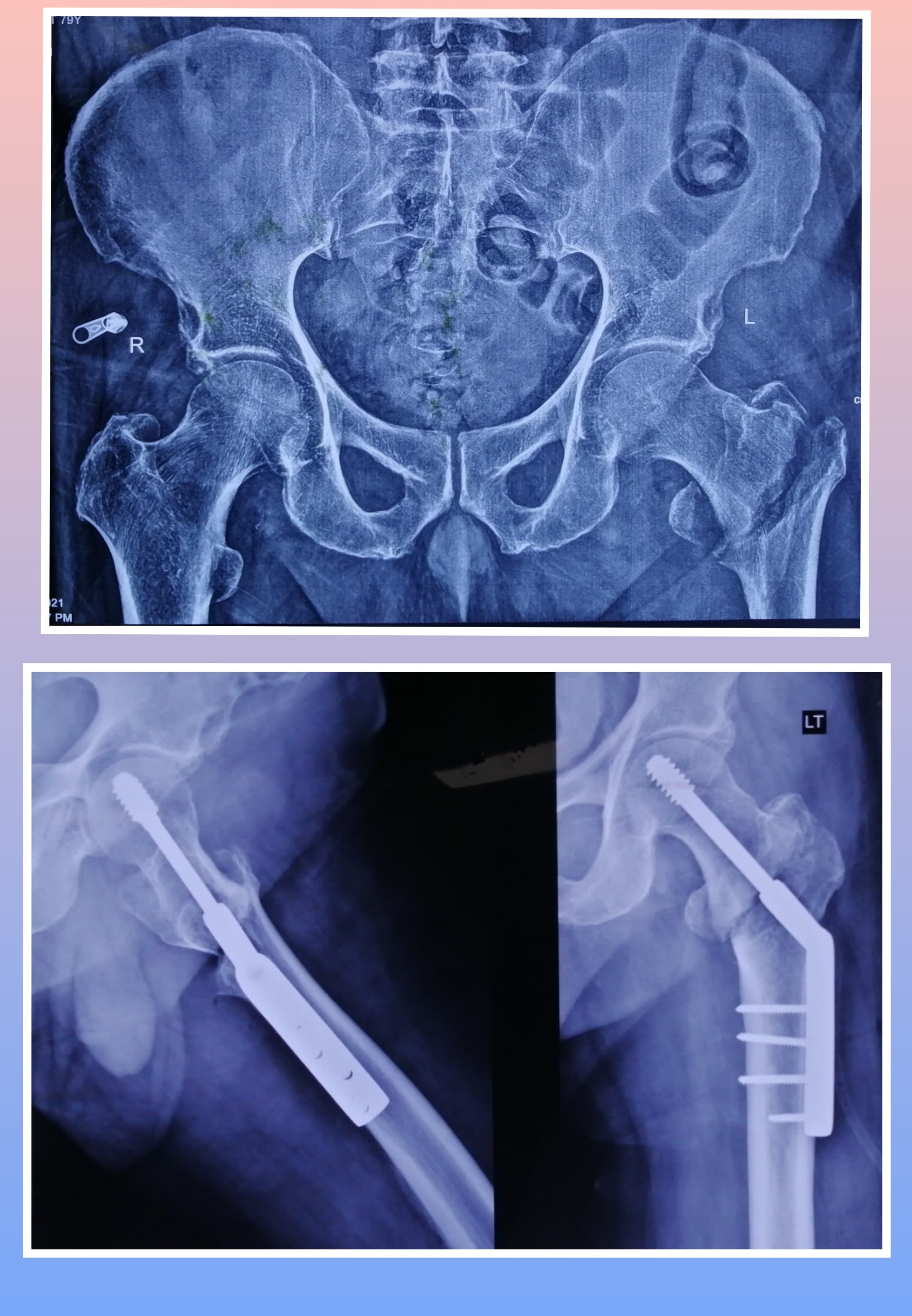 Xray Image