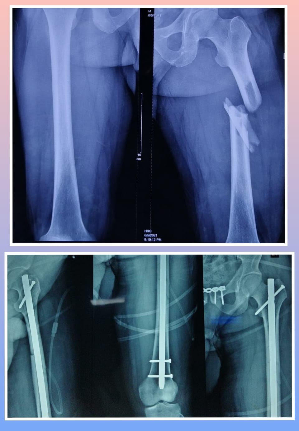 Xray Image