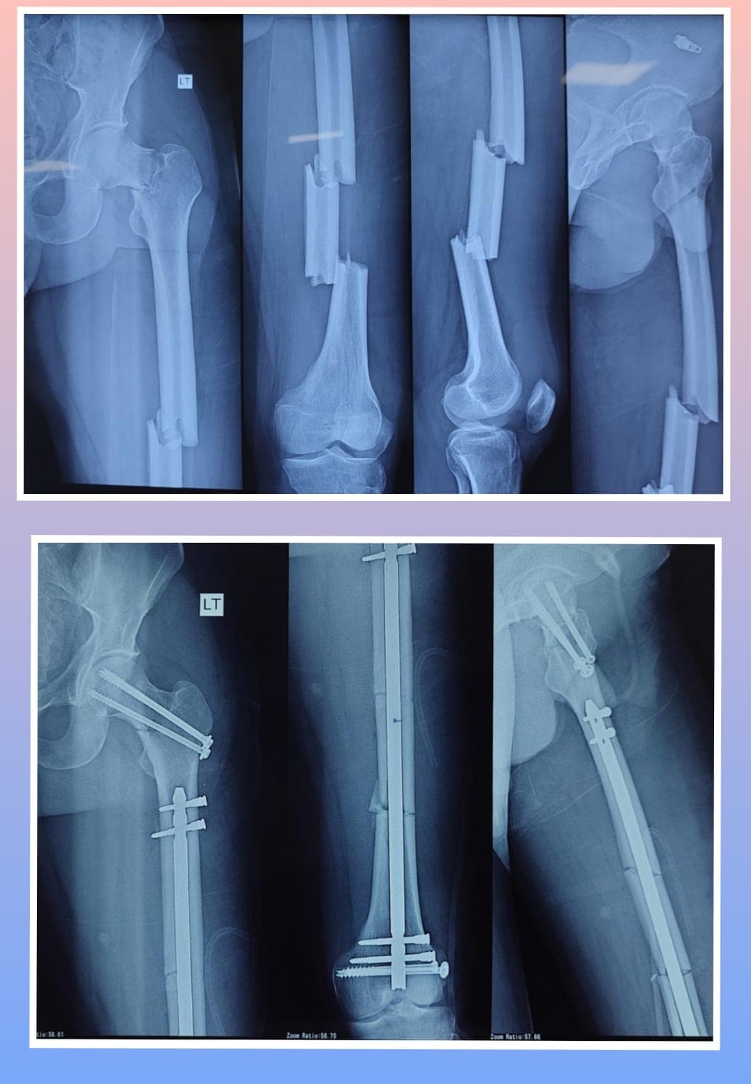 Xray Image