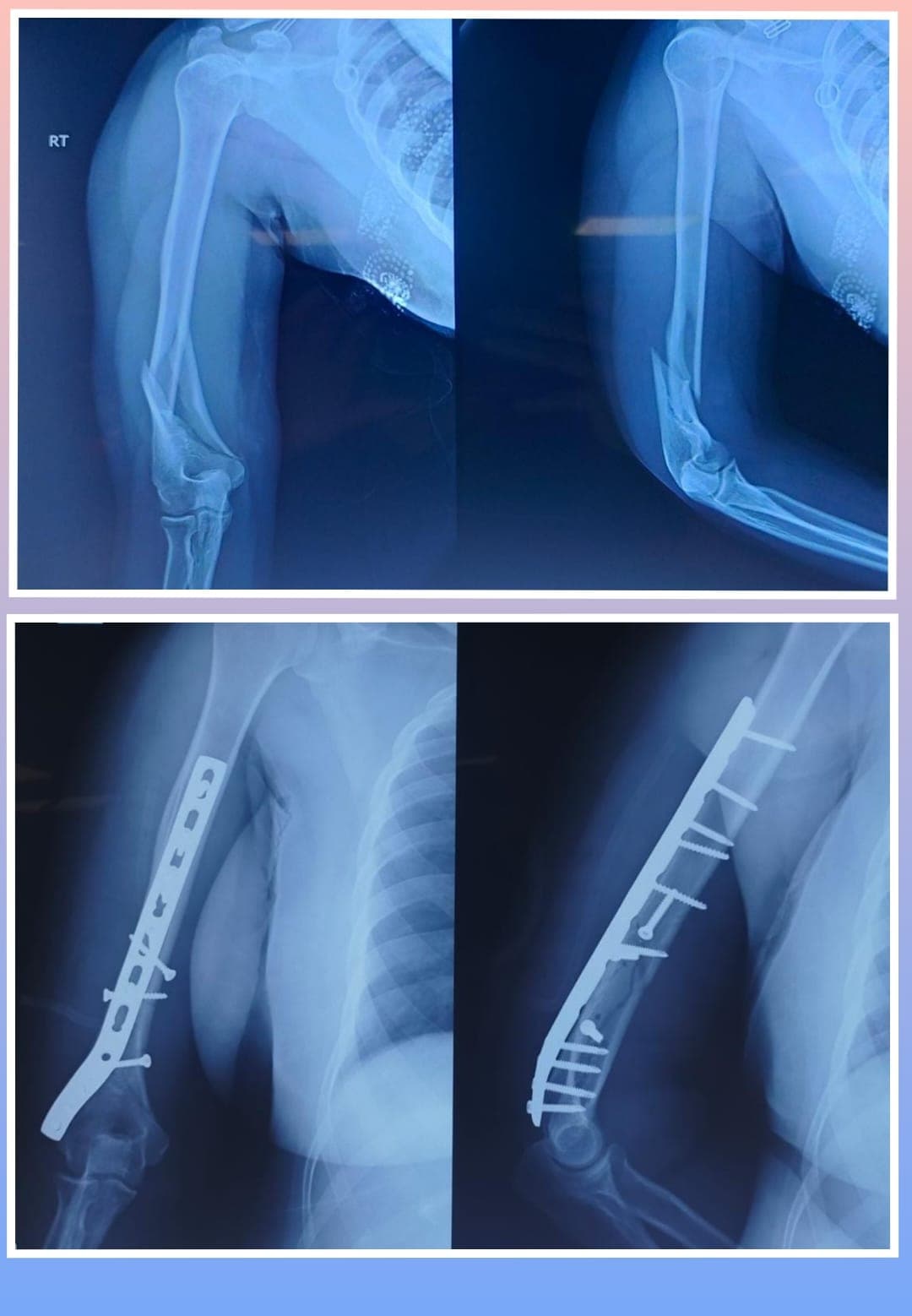 Xray Image