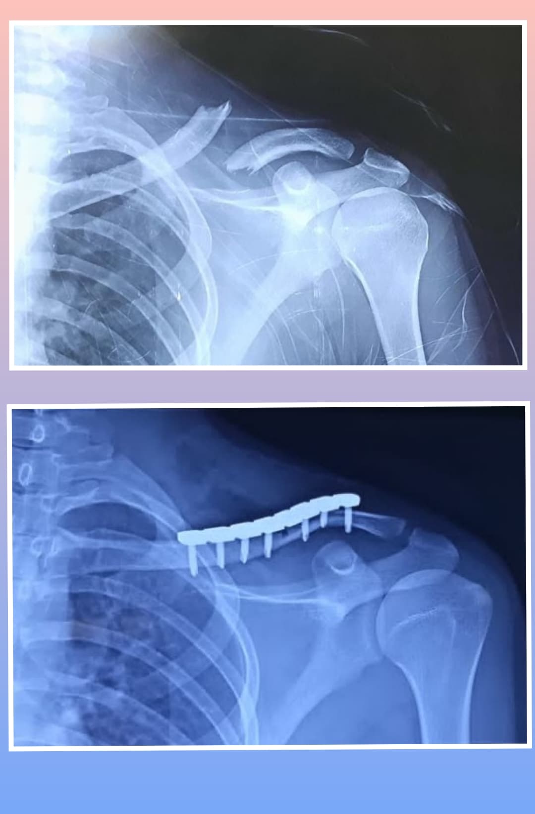 Xray Image
