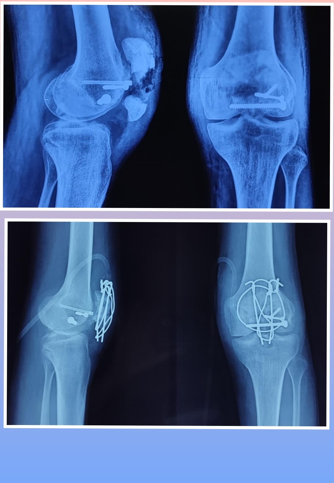 Xray Image