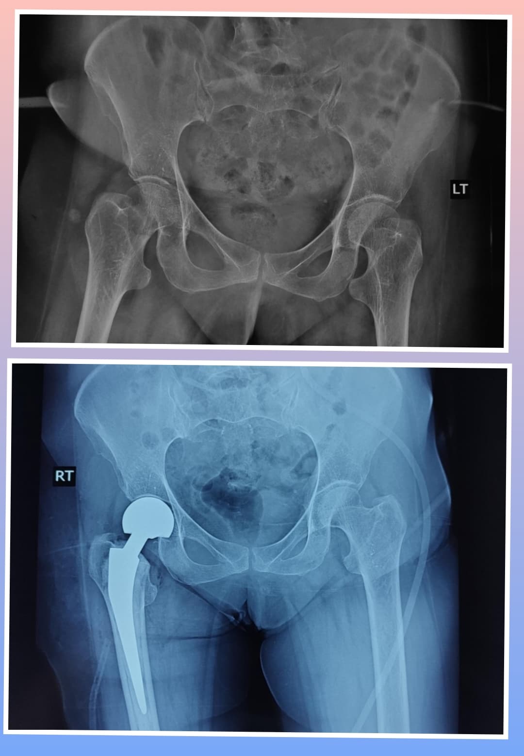 Xray Image