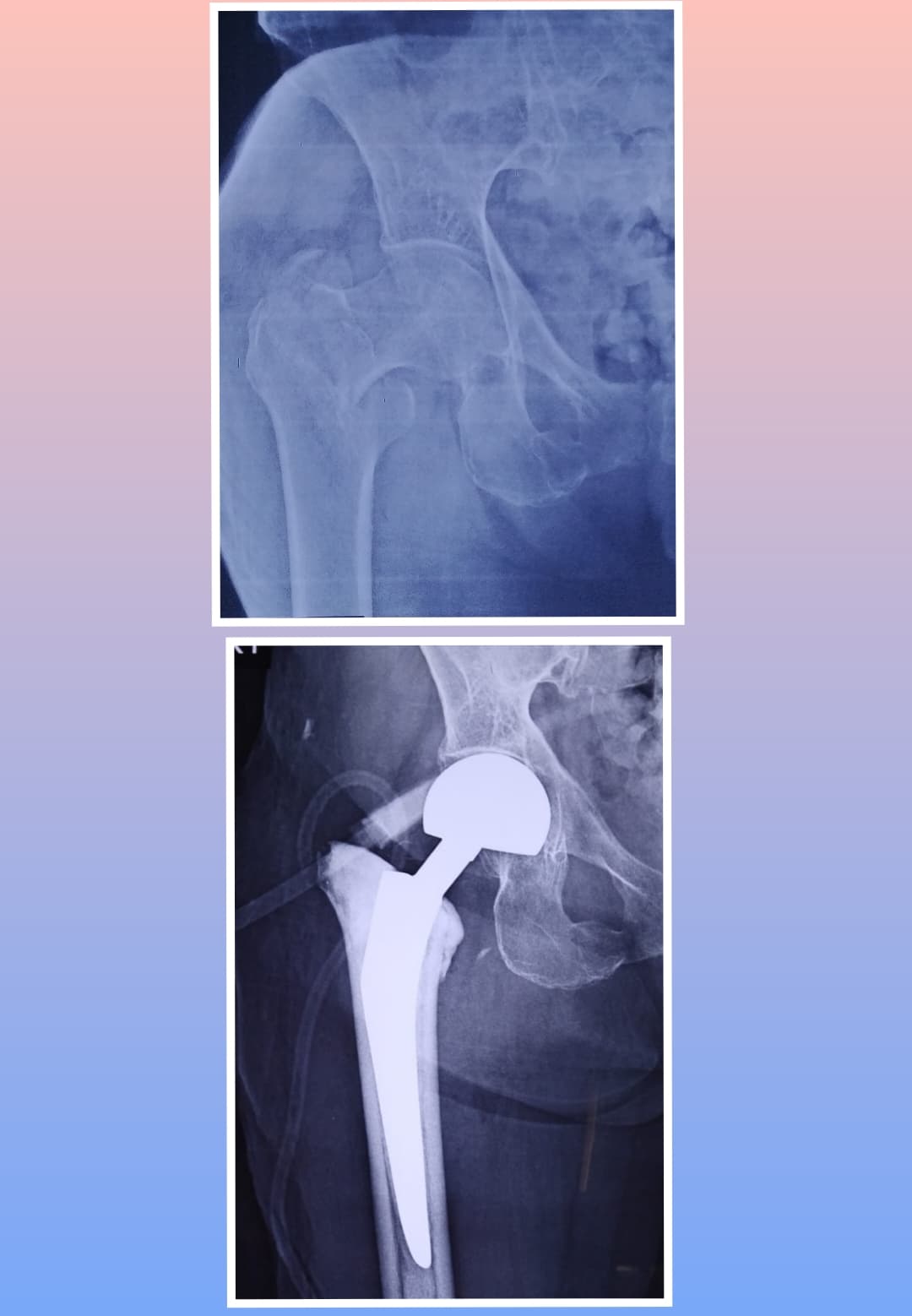 Xray Image