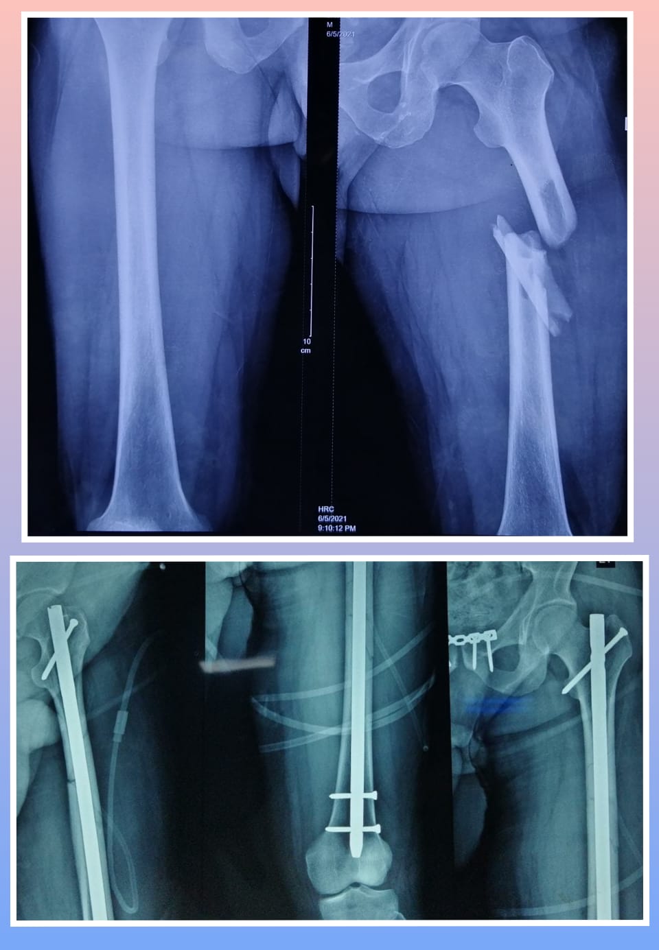 Xray Image