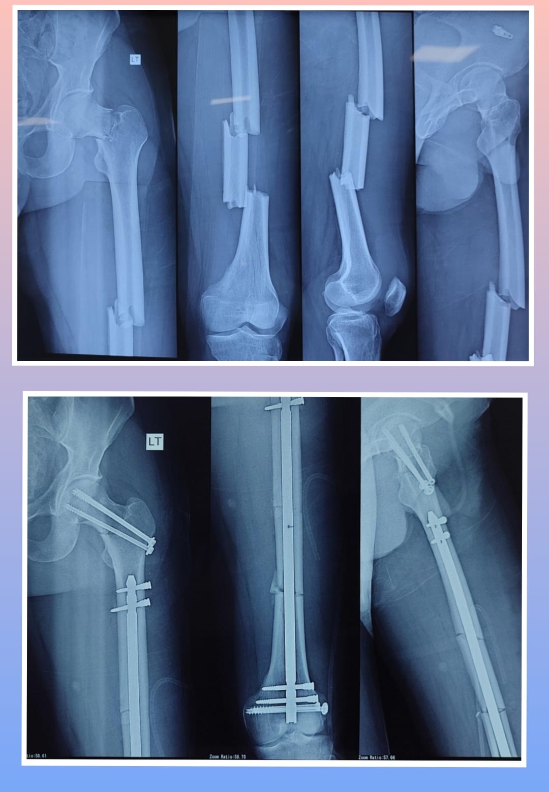 Xray Image