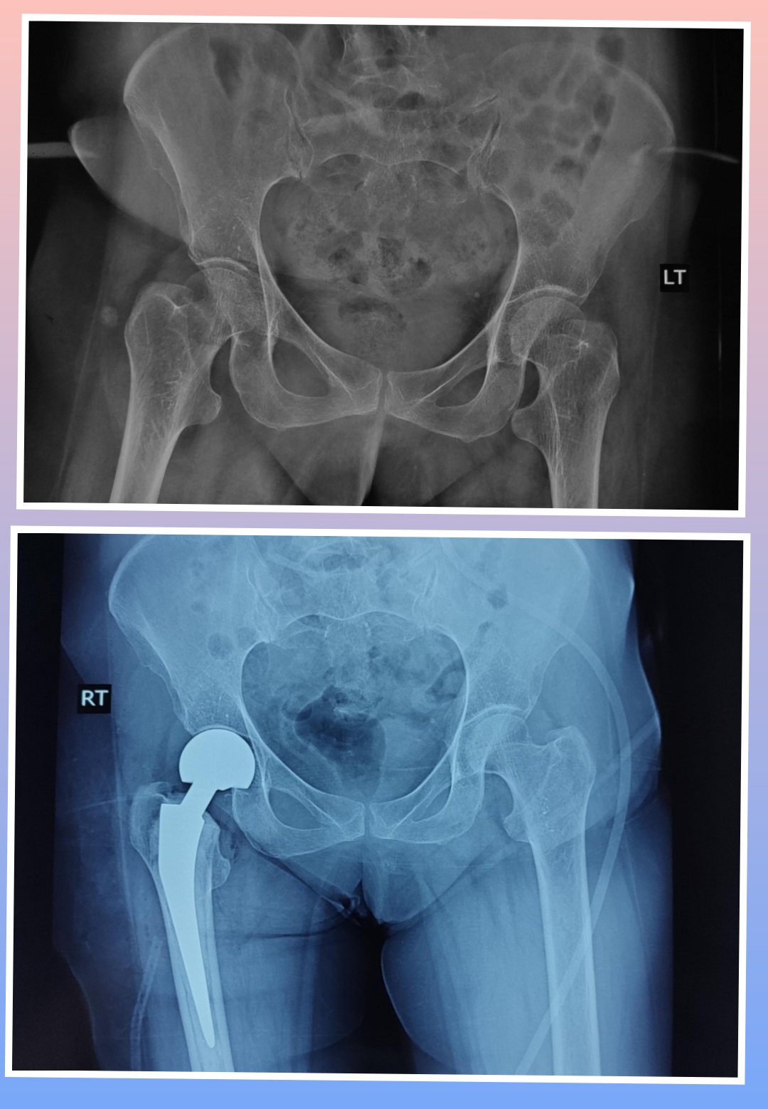 Xray Image